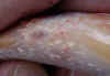 damage on koi from costia