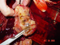 This shows that the tumor had encased all the organs in the abdomen, the gall bladder, the liver, and the intestinal track